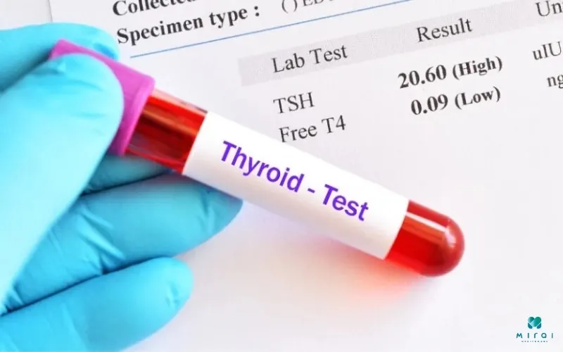 ket-hop-cac-chi-so-tsh-va-ft4-chuc-nang-tuyen-giap