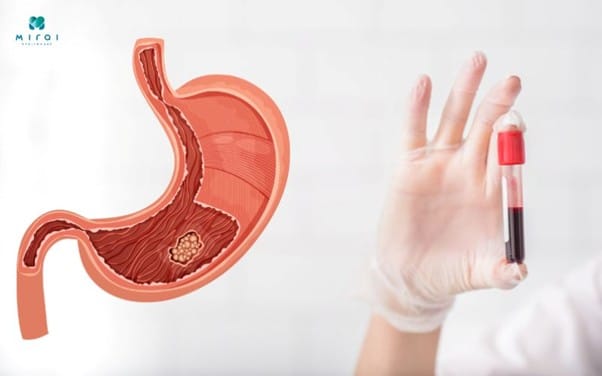 vai-tro-cua-xet-nghiem-mau-trong-tam-soat-ung-thu-da-day