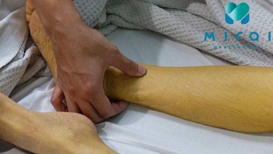 benh-vang-da-do-tang-bilirubin-gian-tiep