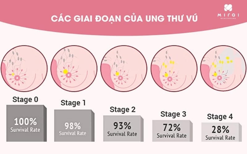 cac-giai-doan-cua-ung-thu-vu