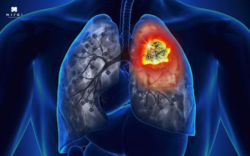 cac-loai-ung-thu-pho-bien