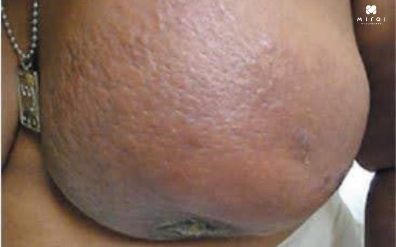 mot-so-hinh-anh-ung-thu-vu-02