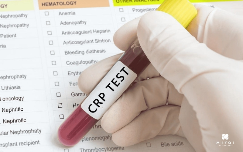Xét nghiệm CRP thông thường theo dõi các tình trạng viêm cấp