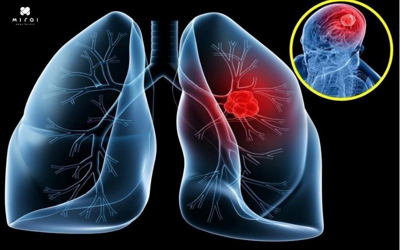 Tầm soát ung thư phổi hàng năm với người hút nhiều thuốc lá