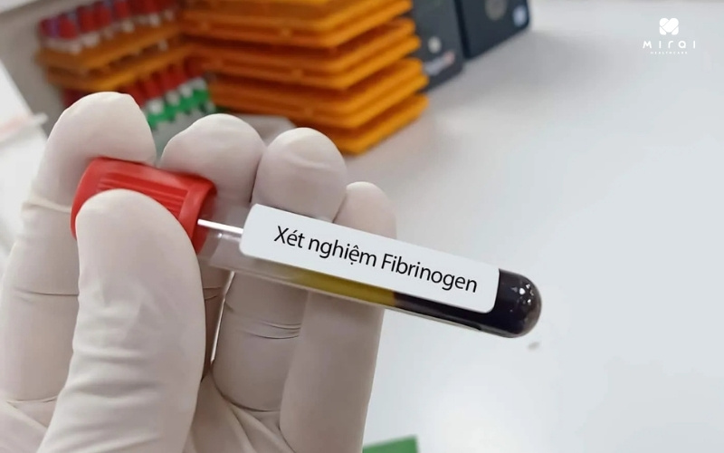 Xét nghiệm fibrinogen đánh giá khả năng hình thành cục máu đông