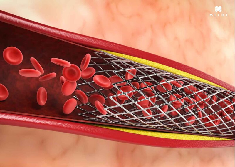 Xét nghiệm fibrinogen chẩn đoán rối loạn đông máu