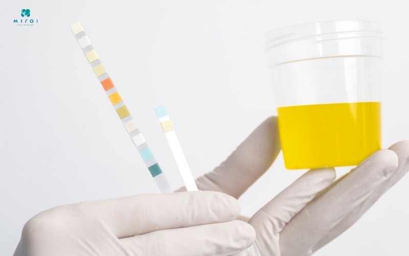 Xét nghiệm nước tiểu thường không cần nhịn ăn
