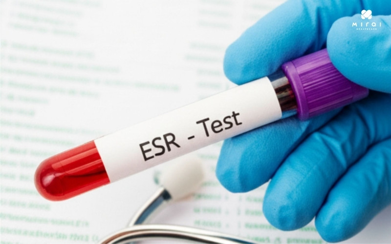 Chỉ số ESR cao liên quan đến viêm, nhiễm trùng