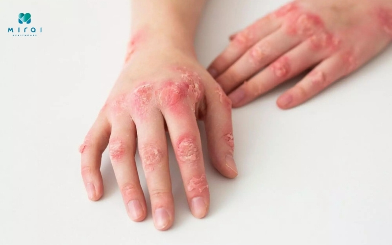 Xét nghiệm ESR để chẩn đoán Lupus ban đỏ