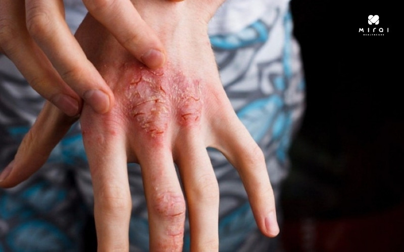 Khi có dấu hiệu nghi ngờ bạn nên làm xét nghiệm giun sán