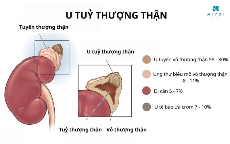 chi-so-catecholamin-cao-canh-bao-u-tuy-thuong-than
