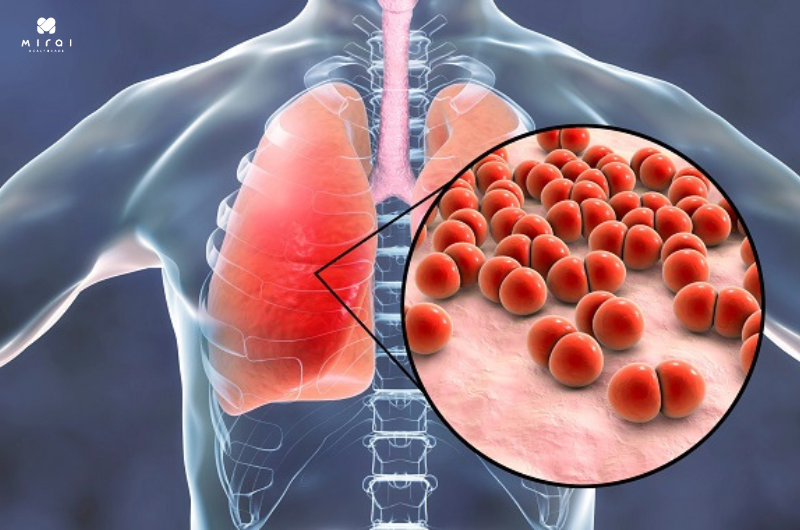 nguoi-benh-bi-viem-phoi