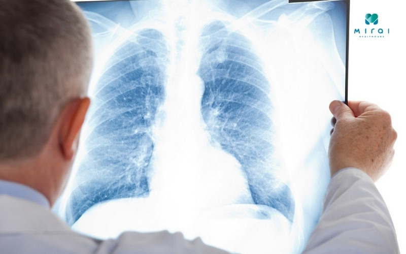 viem-phoi-la-mot-benh-nhiem-trung-nghiem-trong-xay-ra-o-phoi