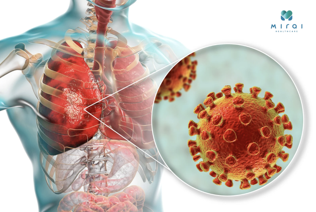 viem-phoi-se-gay-ho-keo-dai-va-suy-giam-chuc-nang-ho-hap