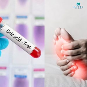 xet-nghiem-acid-uric-va-y-nghia-chi-so-gout-roi-loan-chuyen-hoa