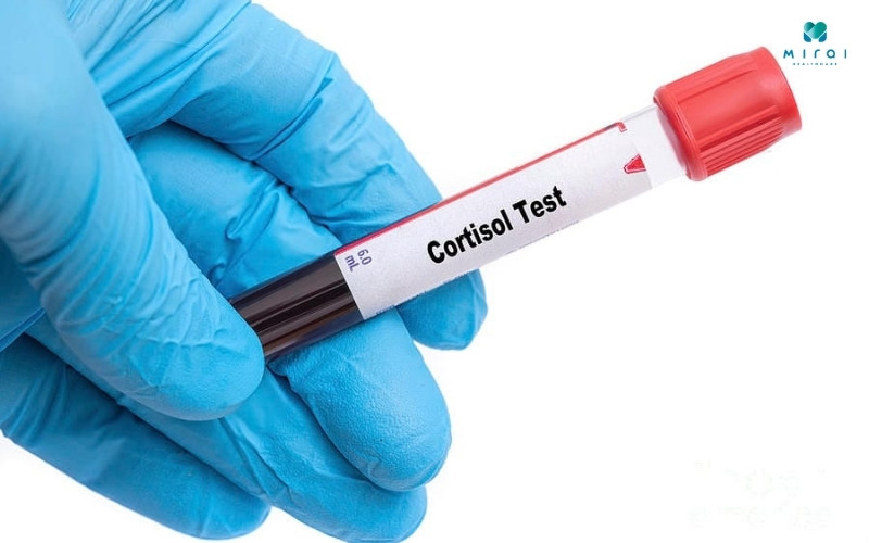 xet-nghiem-cortisol-la-do-nong-do-hormone-cortisol-trong-co-the