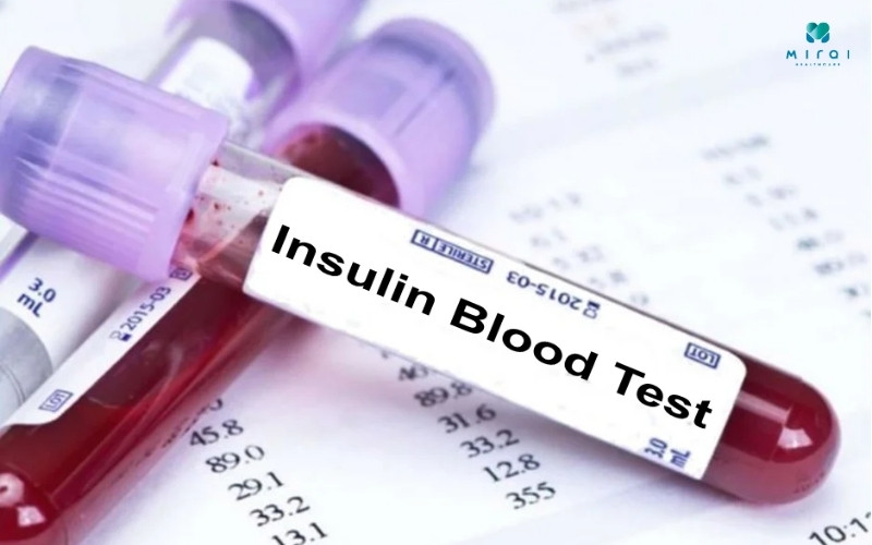 xet-nghiem-insulin-chan-doan-benh-ly-tieu-duong