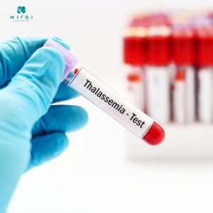 xet-nghiem-thalassemia-giup-chan-doan-tan-mau-bam-sinh