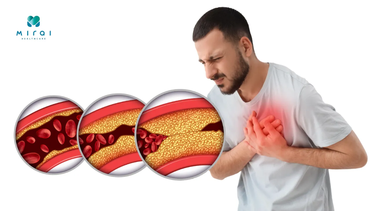 Co thắt mạch máu kéo dài có thể dẫn đến đột quỵ và nhồi máu cơ tim