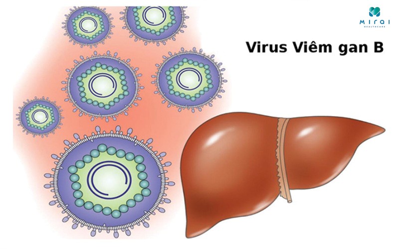 Viêm gan B cấp tính là giai đoạn nhiễm HBV trong thời gian ngắn