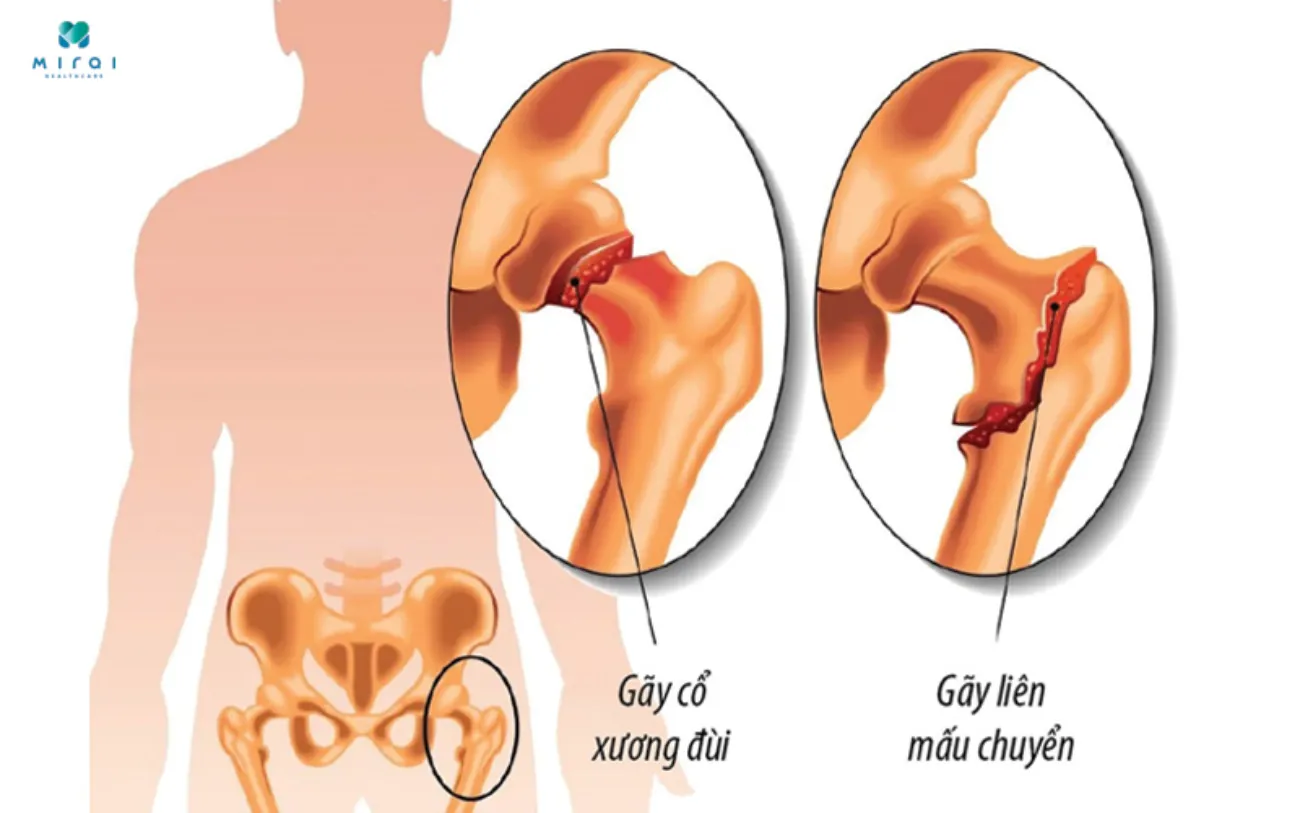 Loãng xương dễ dẫn tới gãy xương ở phụ nữ