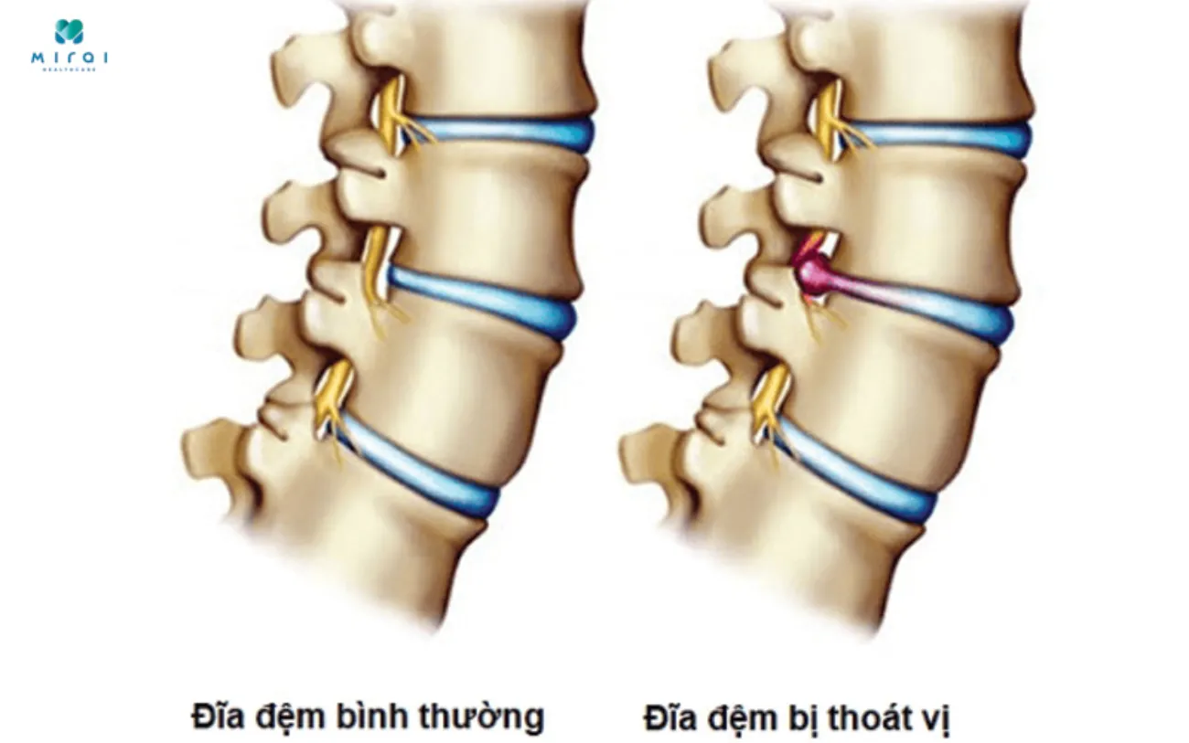 Phân biệt đĩa đệm bình thường và đĩa đệm bị thoát vị
