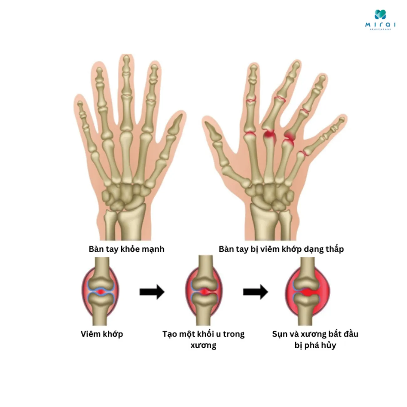 Phân biệt hình thái xương bị viêm khớp dạng thấp