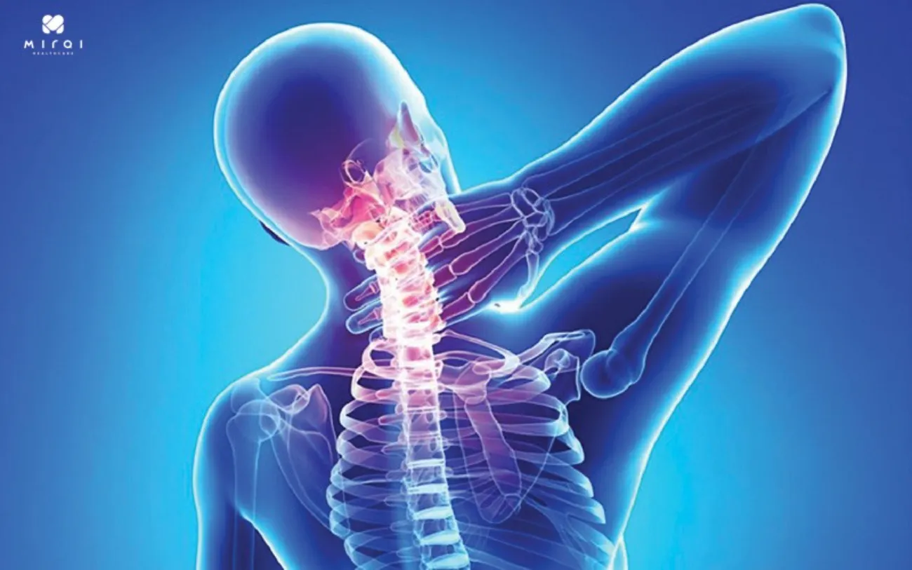 Thoái hóa cột sống cổ là nguyên nhân phổ biến nhất gây đau vai gáy kéo dài