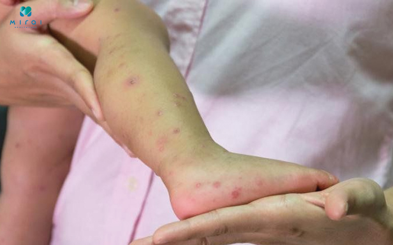 Phát ban là dấu hiệu điển hình của bệnh