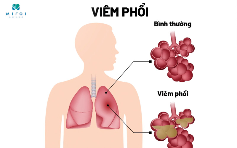 Biến chứng viêm phổi do ho gà tiến triển nhanh, cần cấp cứu kịp thời
