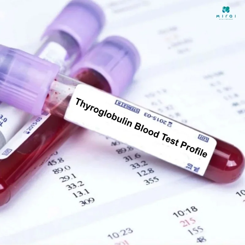 xet-nghiem-tg-trong-tuyen-giap