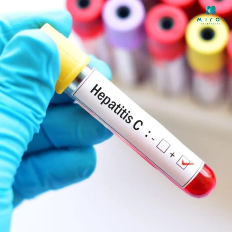 cac-xet-nghiem-viem-gan-c