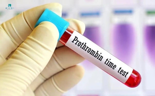 cac-xet-nghiem-xo-gan-nong-do-prothrombin