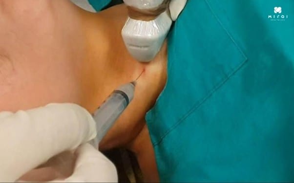 chi-phi-xet-nghiem-fna-tuyen-giap