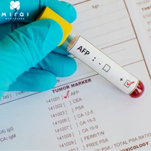 chi-so-afp-trong-mau-bao-nhieu-la-binh-thuong