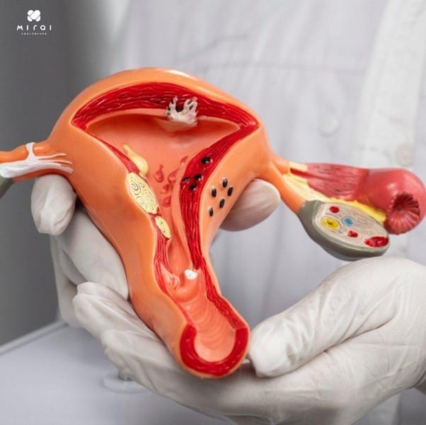 tam-soat-ung-thu-buong-trung-thumbnail