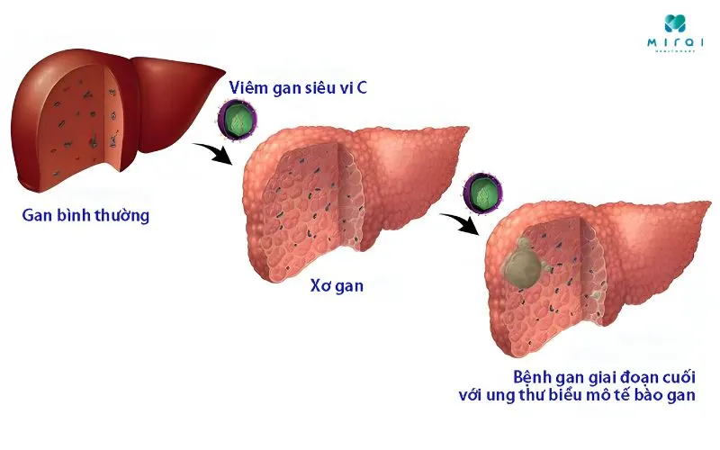 virus-viem-gan-c-co-kha-nang-gay-ton-thuong-te-bao-gan
