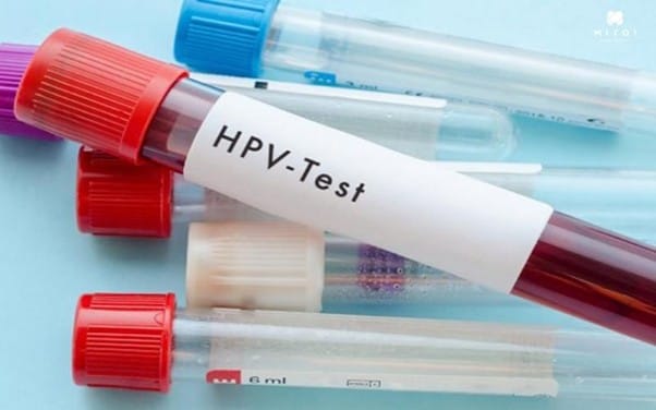 cac-phuong-phap-chan-doan-benh-sui-mao-ga-hpv-pcr