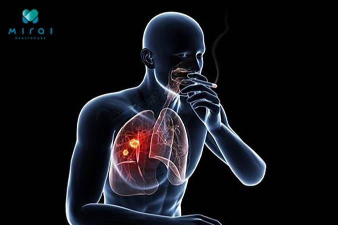 chi-dinh-xet-nghiem-cyfra-21-1-khi-nao