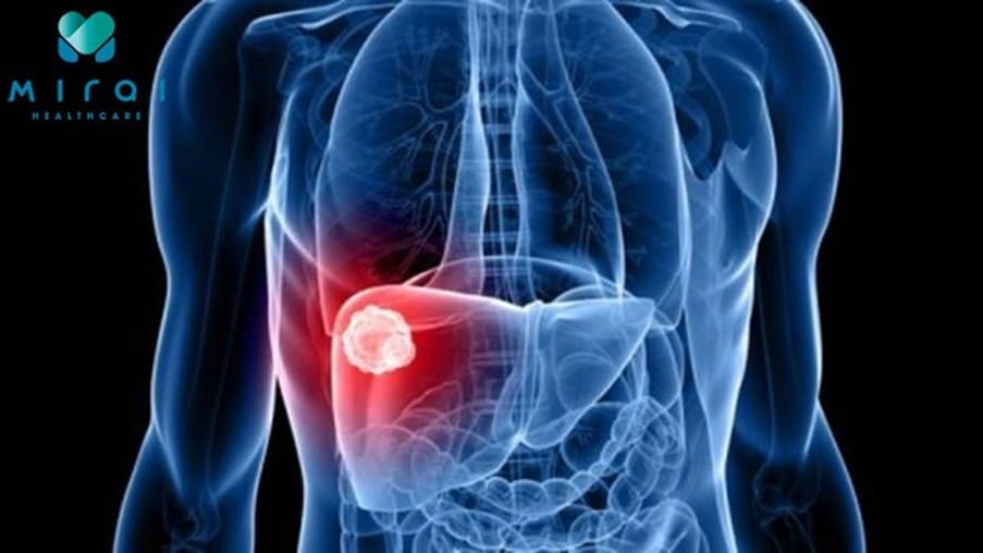 thong-tin-ve-ung-thu-bieu-mo-te-bao-gan