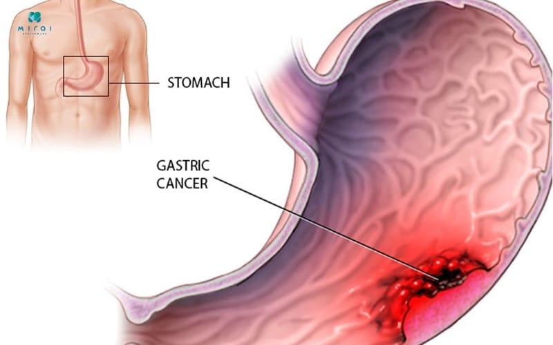ung-thu-da-day-la-gi