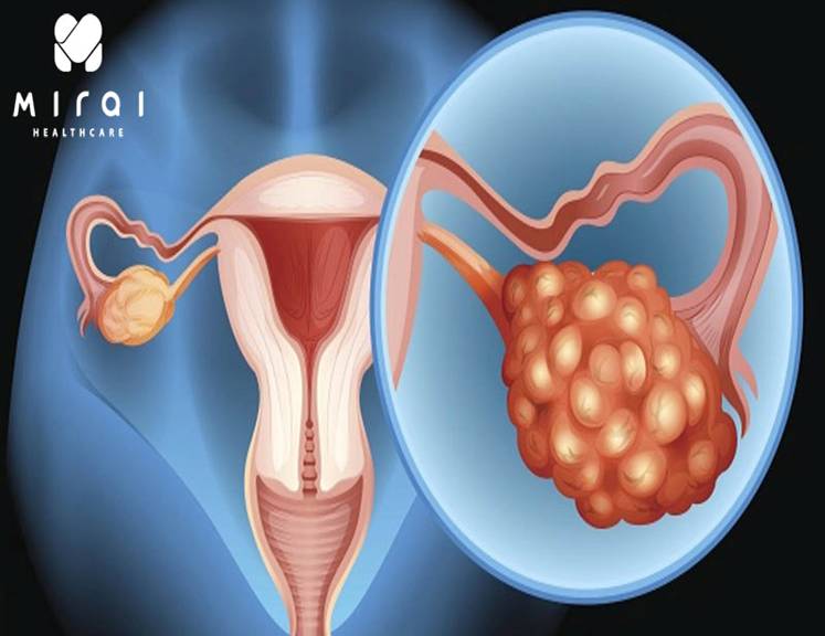 xet-nghiem-ca-125-trong-chan-doan-ung-thu-buong-trung-thumbnail