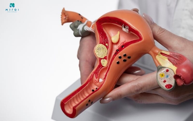 xet-nghiem-ca-72-4-trong-phat-hien-ung-thu-buong-trung