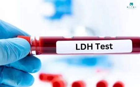 xet-nghiem-mau-co-phat-hien-ung-thu-xuong-khong