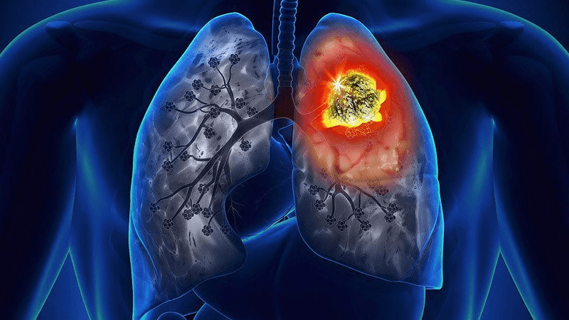 xet-nghiem-nse-la-gi