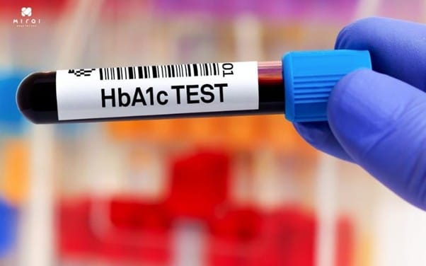 xet-nghiem-tieu-duong-co-can-nhin-an-khong-xet-nghiem-hba1c