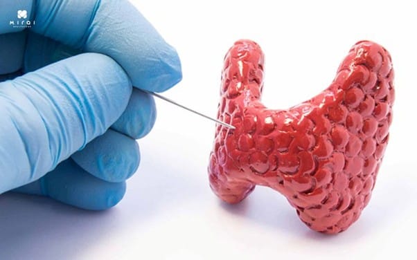 xet-nghiem-tuyen-giap-bao-lau-co-ket-qua-03