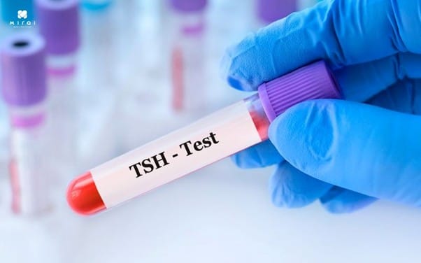 xet-nghiem-tuyen-giap-bao-lau-co-ket-qua