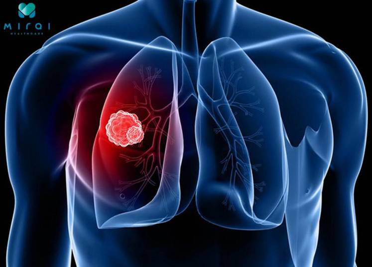 y-nghia-cua-xet-nghiem-cyfra-21-1-trong-chan-doan-ung-thu-phoi