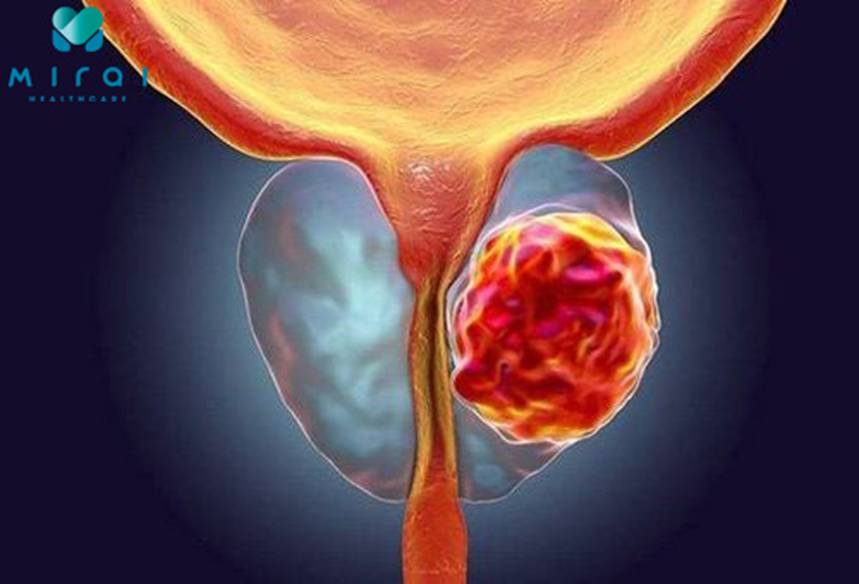 chi-dinh-xet-nghiem-psa-khi-nao